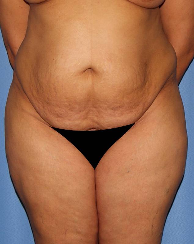 Tummy Tuck Abdominoplasty Connecticut - Amazing Results from Tummy