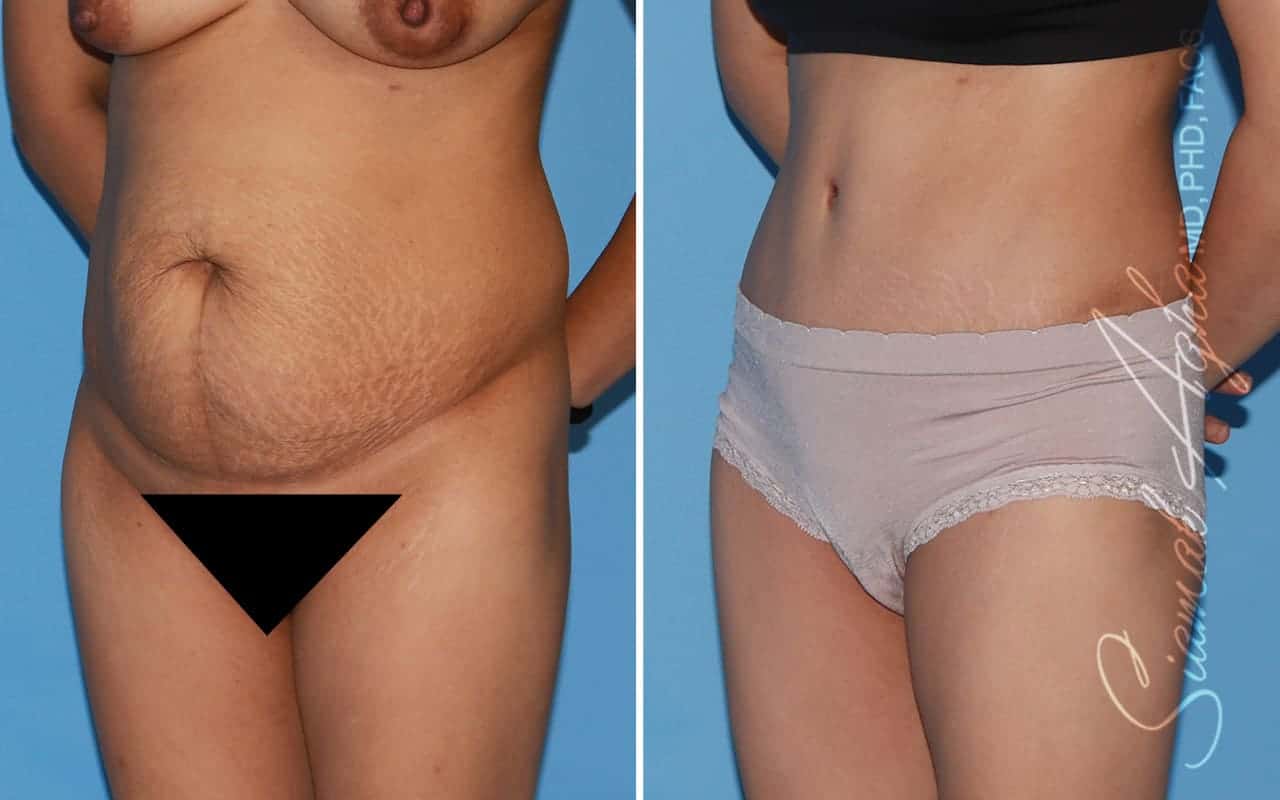 Tummy Tuck Revision Patient 54