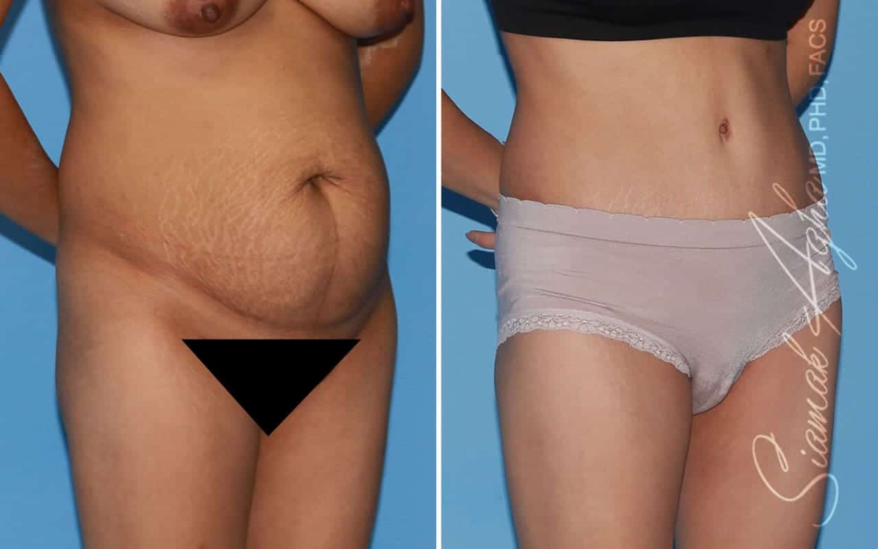 Tummy Tuck Revision Patient 54