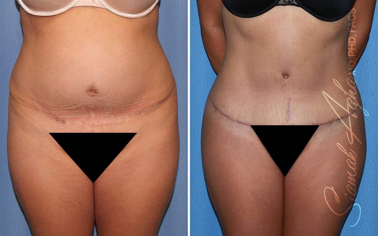 Tummy Tuck Revision Patient 73