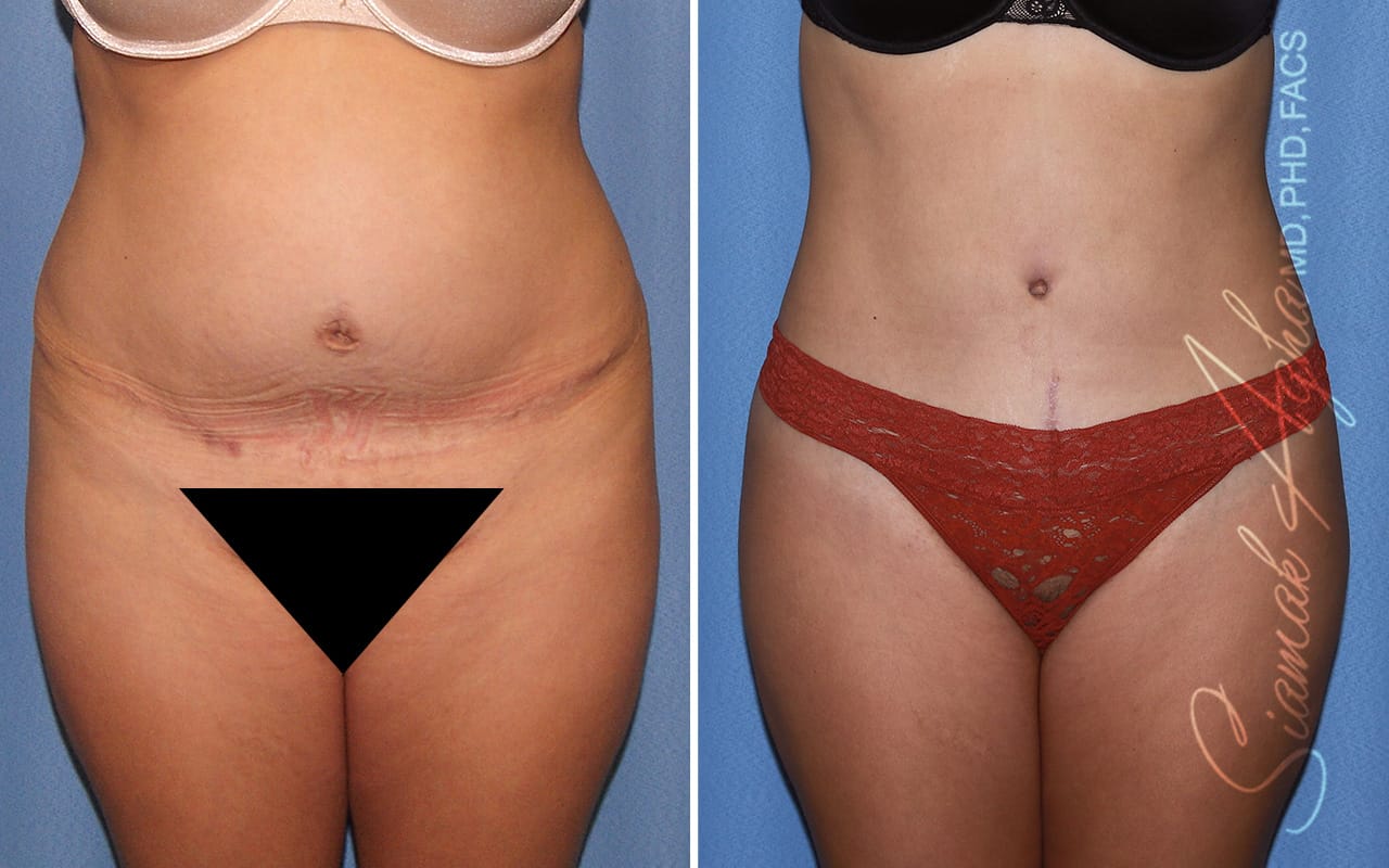 Tummy Tuck Revision Patient 73