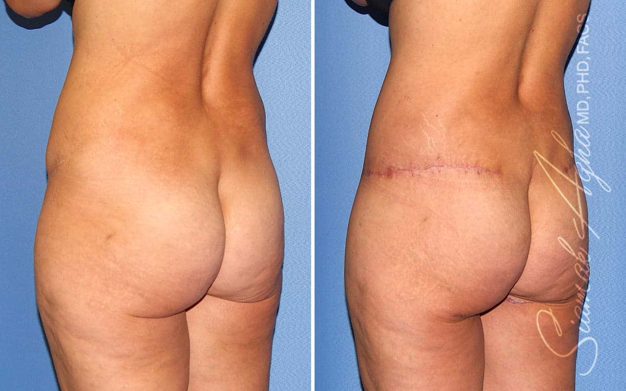 Tummy Tuck Revision Patient 74