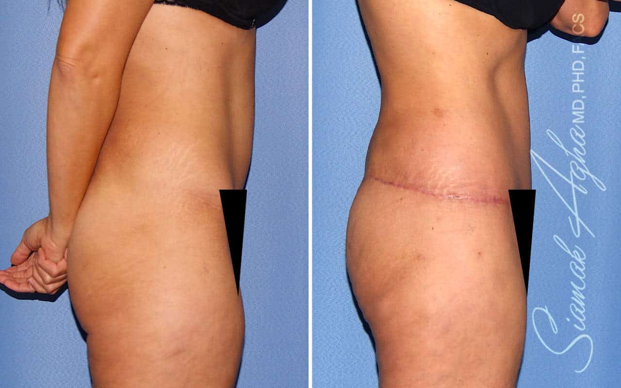 Tummy Tuck Revision Patient 74