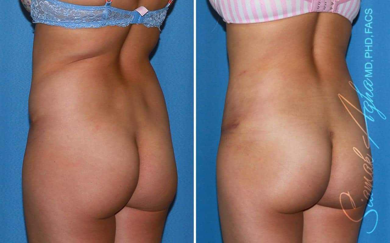 Tummy Tuck Revision Patient 88