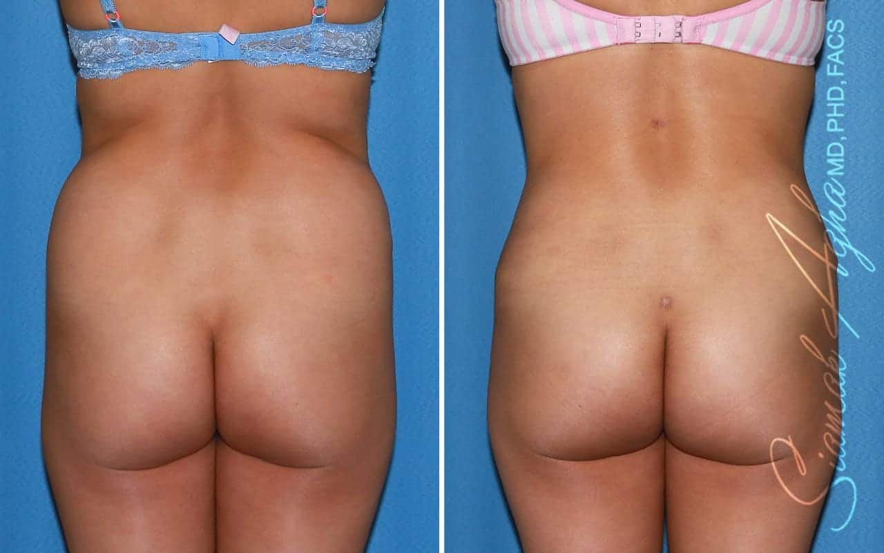 Tummy Tuck Revision Patient 88