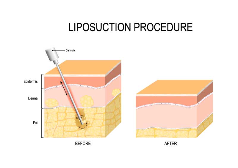 Illusatration of the liposuction