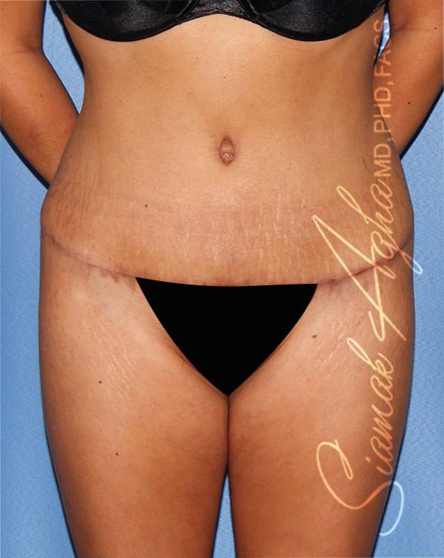 Tummy Tuck Surgery Before & After Photo Gallery - Patient #49