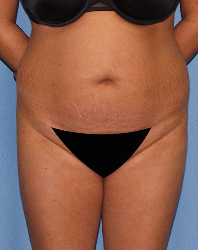 How can I expect my belly to look after a tummy tuck? - Dr. Ali