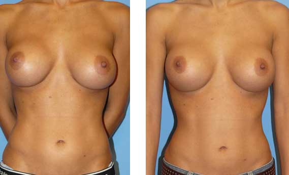 Guide to Breast Implant Complications