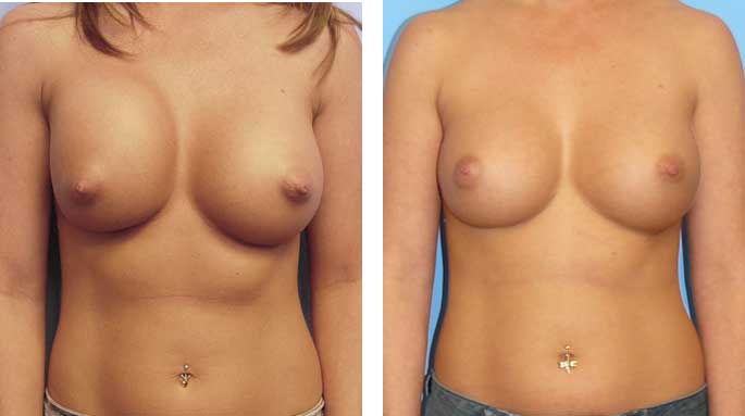 Guide to Breast Implant Complications