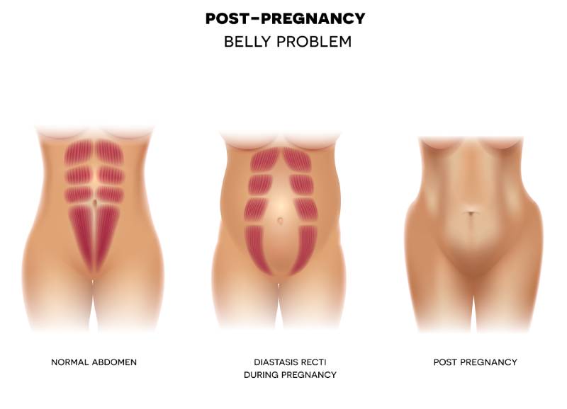 Diastasis recti, the post-pregnancy belly problem, explained - Vox