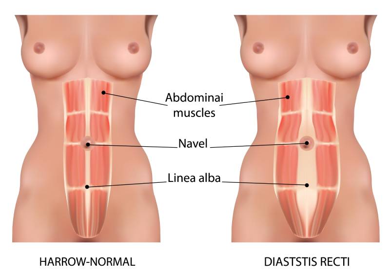 Understanding The Abdomen Diastasis Recti in Pregnancy