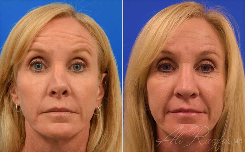 Face Procedures Before and After Photo Gallery
