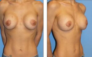 Secondary Breast Augmentation Newport Beach