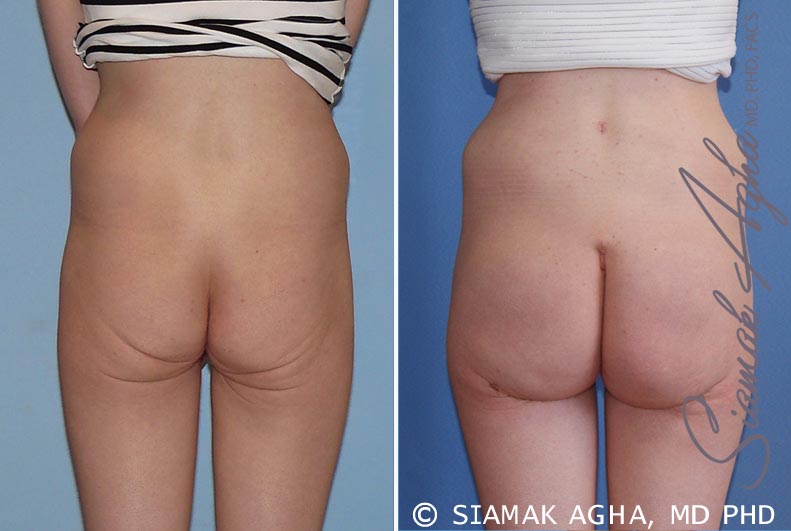 Buttocks Procedures Before and After Photo Gallery