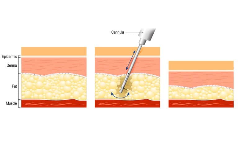 Does your body produce fat cells after liposuction?