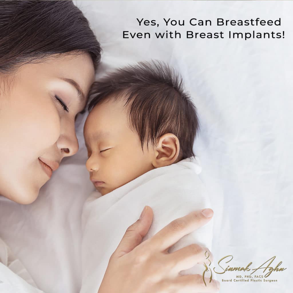 Yes, you can breastfeed even with breast implants - Instagram Post Image