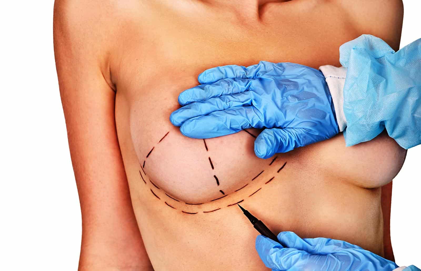Can You Guess When The First Successful Breast Augmentation Surgery Was Performed Newport Beach, CA