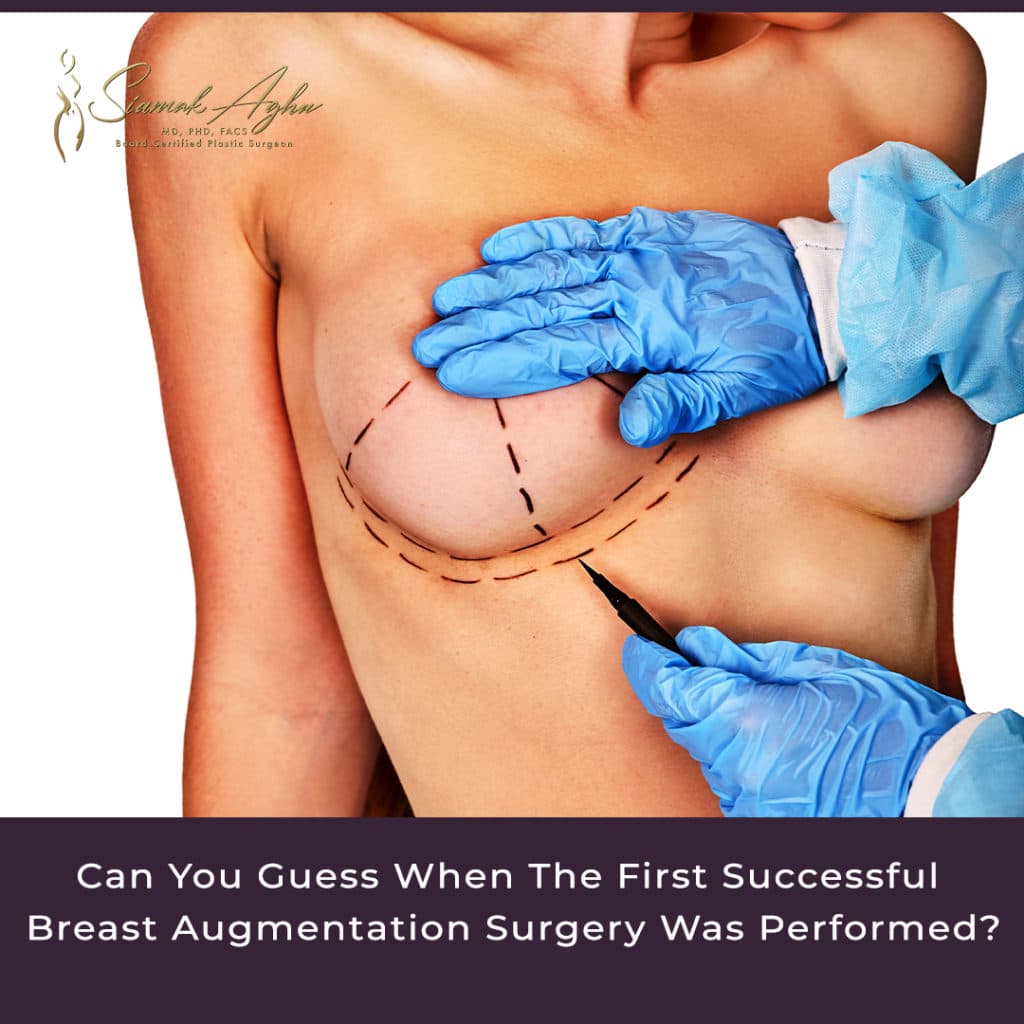Can you guess when the first successful breast augmentation surgery was performed? Instagram Post - Surgeon marking breast