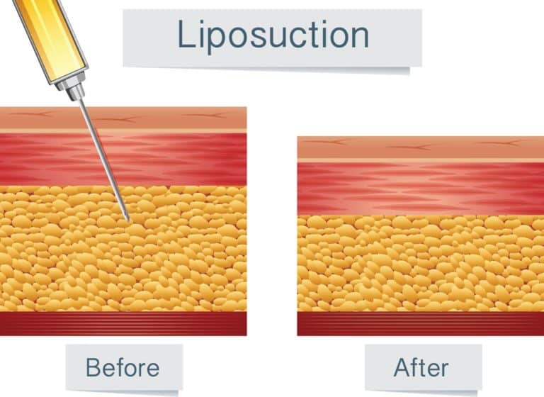 Does your body produce fat cells after liposuction?