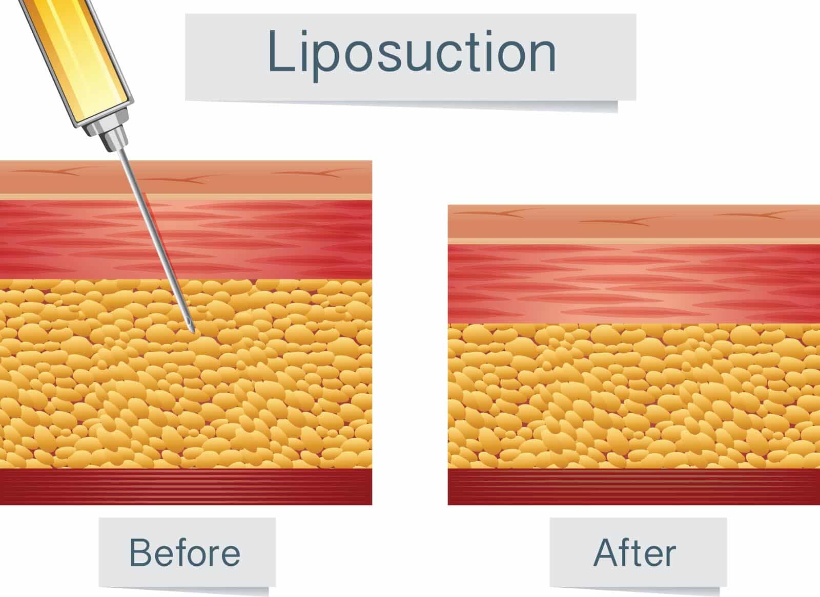 Does your body produce fat cells after liposuction? Newport Beach, CA