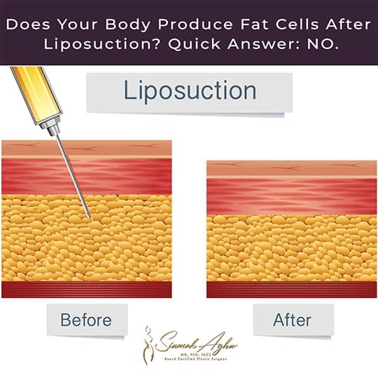 Does your body produce fat cells after liposuction? - Instagram Post - liposuction before and after graphic