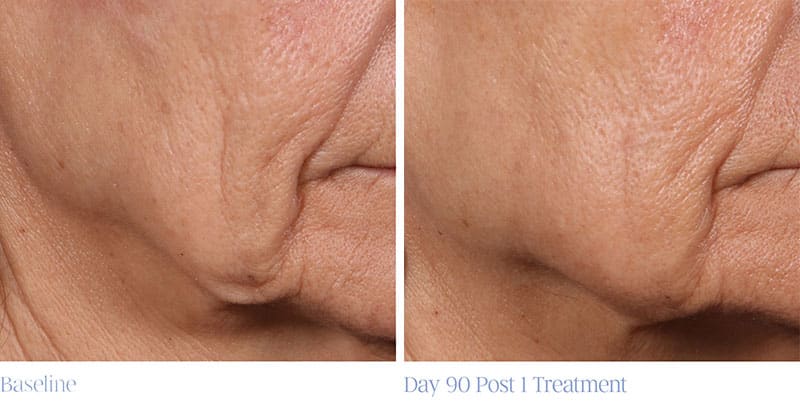 ellacor wrinkle reduction before and after photo - patient 1
