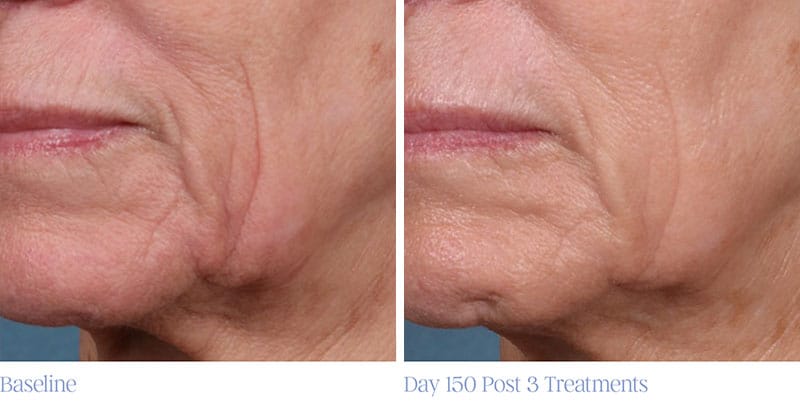 ellacor wrinkle reduction before and after photo - patient 2