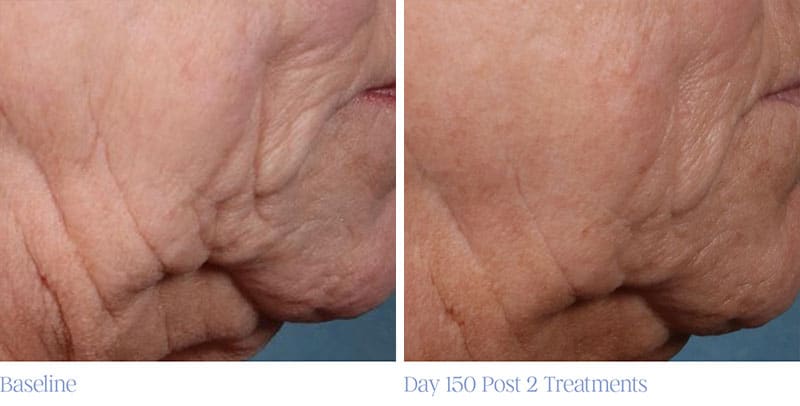 ellacor wrinkle reduction before and after photo - patient 3
