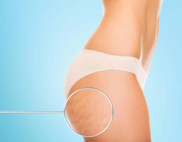 Got Cellulite? Here’s How You Can Get Rid of It the Right Way…