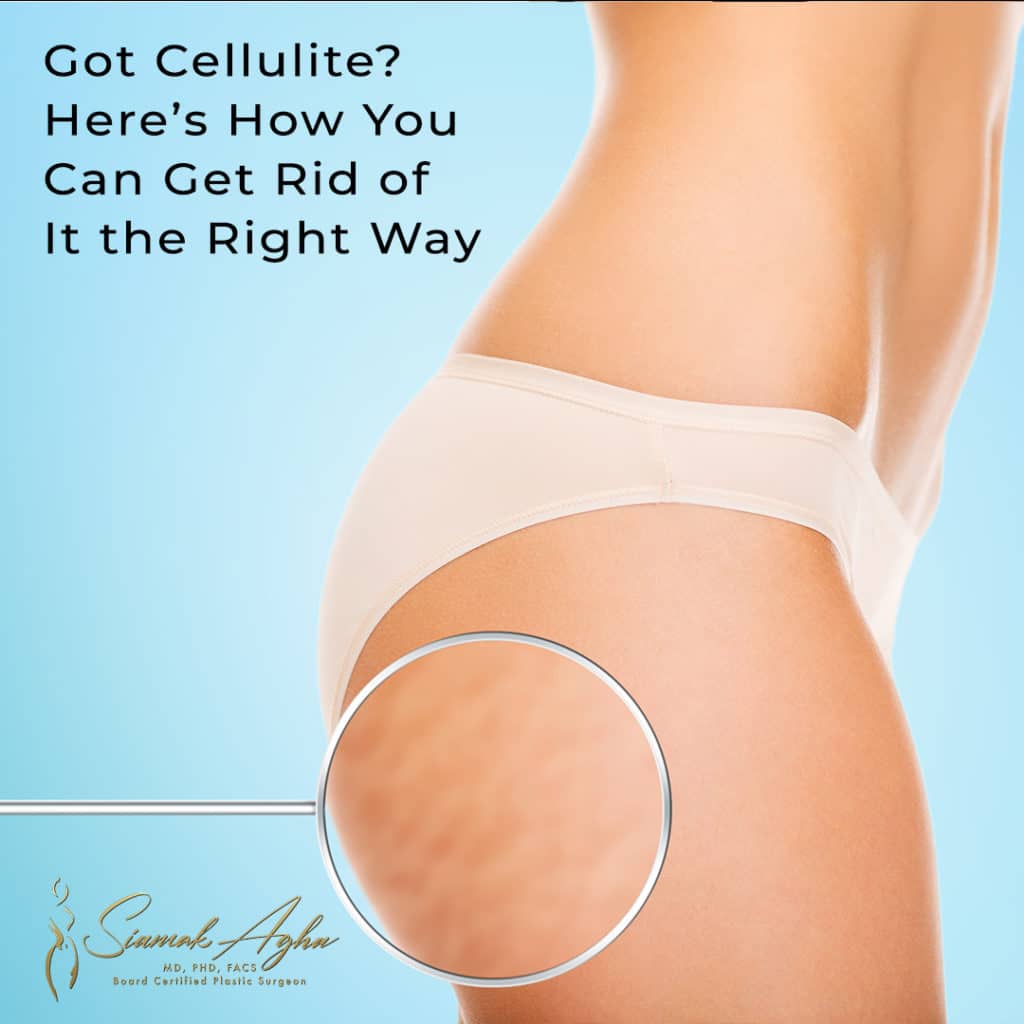 Here's how you can get rid of cellulite right away - Instagram Post - magnifying lens showing cellulite on woman's thigh