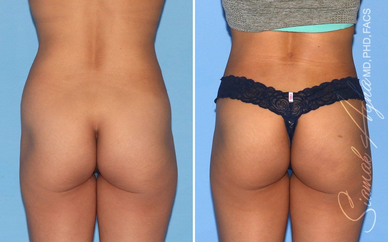 Combined Tummy Tuck and Brazilian Butt Lift Patient 66