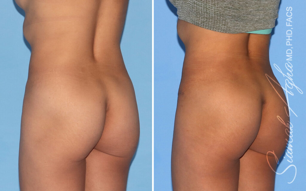 Orange County Brazilian Butt Lift Patient 66 Back Left Newport Beach, CA