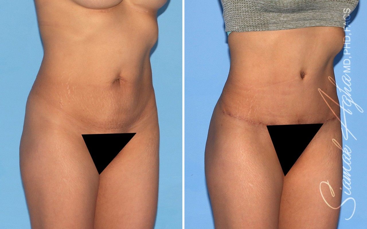 Combined Tummy Tuck and Brazilian Butt Lift Patient 66