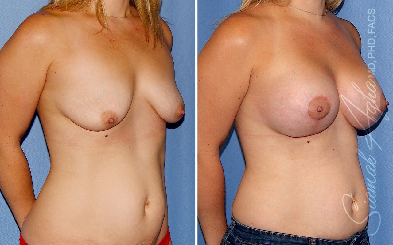Breast Augmentation Patient 43