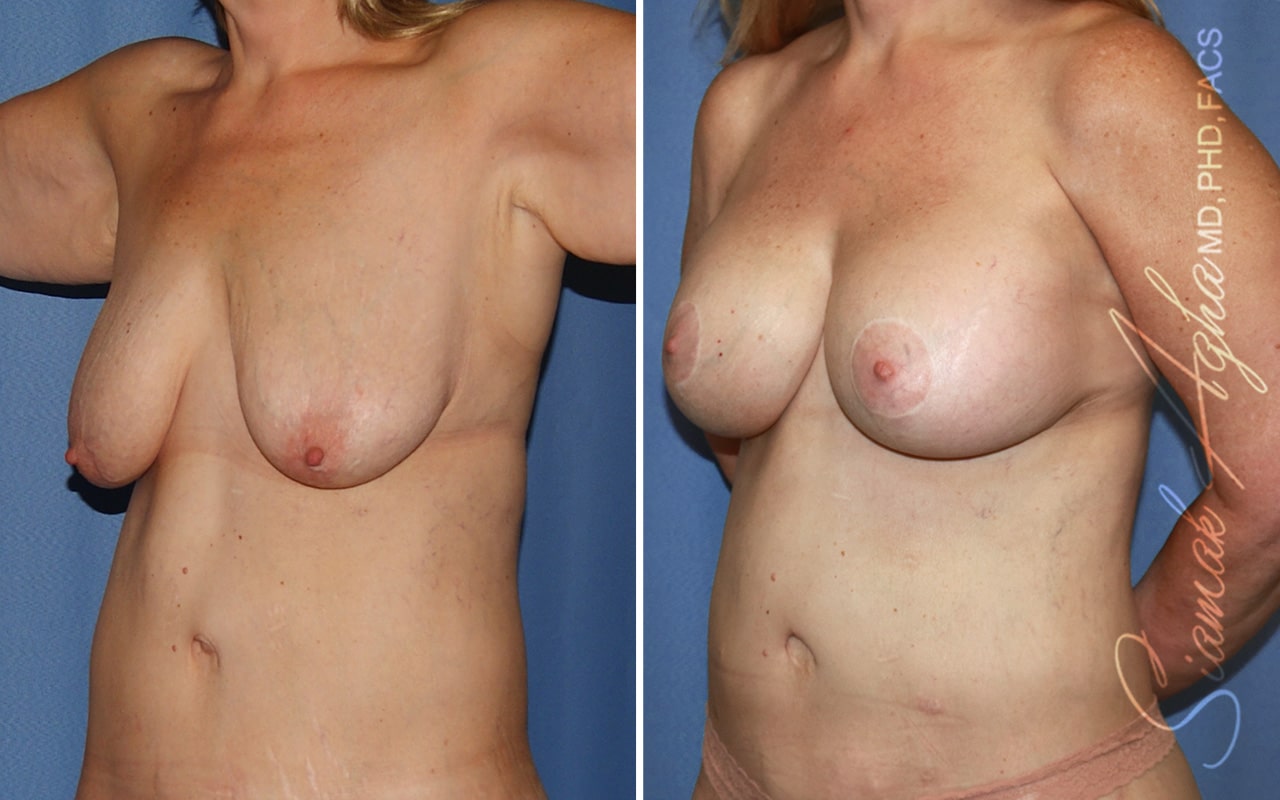 Breast Augmentation Patient 45