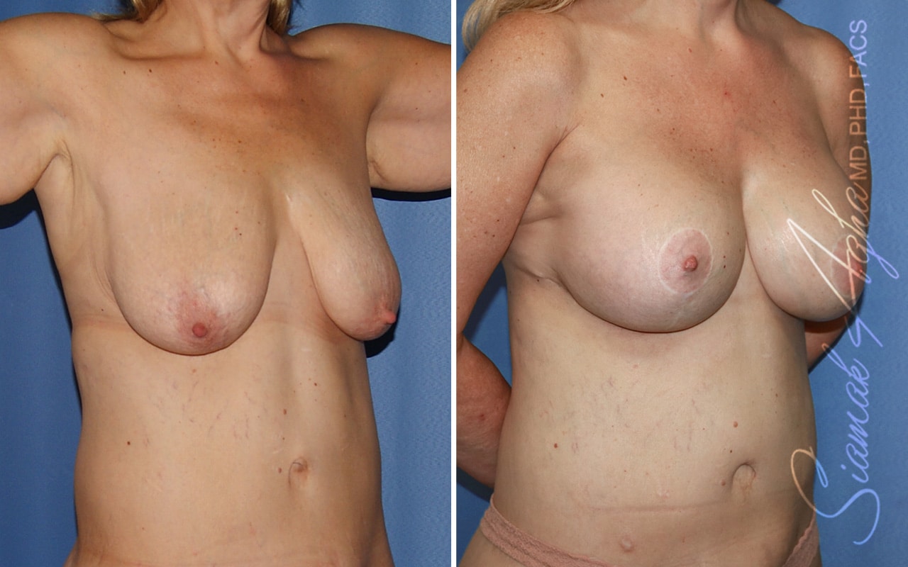 Breast Augmentation Patient 45