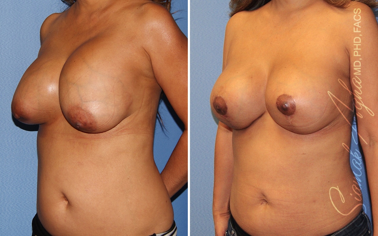 Breast Augmentation Revision Patient 63