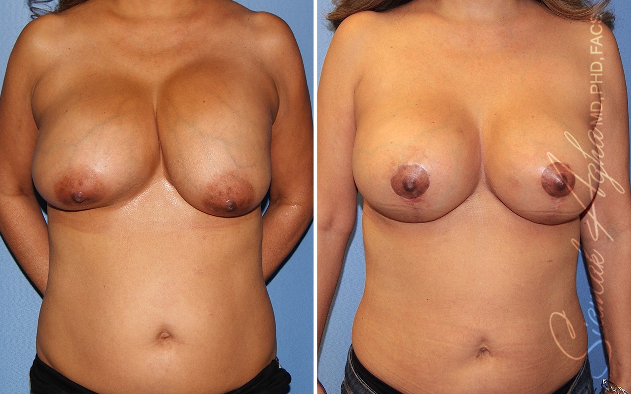 Breast Augmentation Revision Patient 63