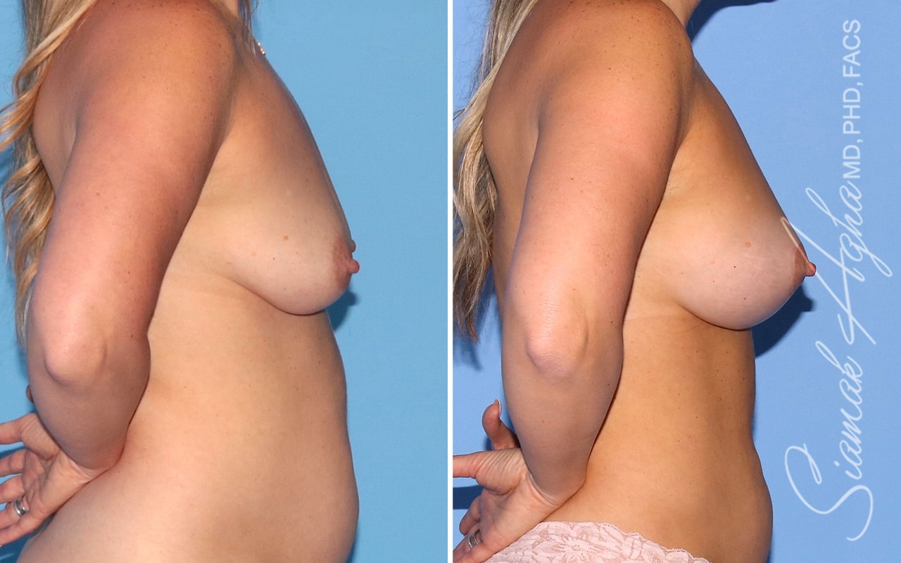 Breast Augmentation Patient 67