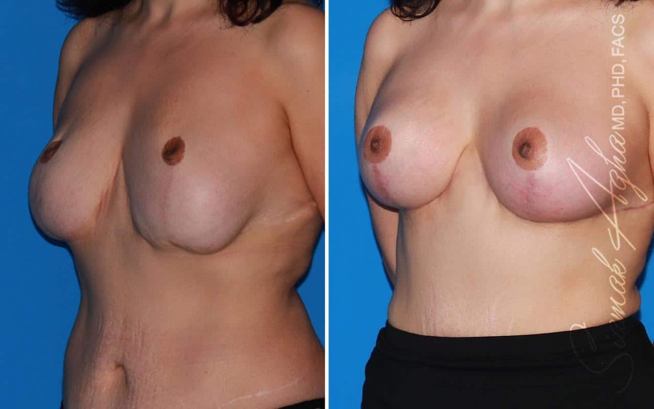 Breast Augmentation Revision Patient 68