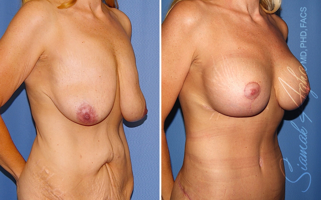 Breast Augmentation Patient 70