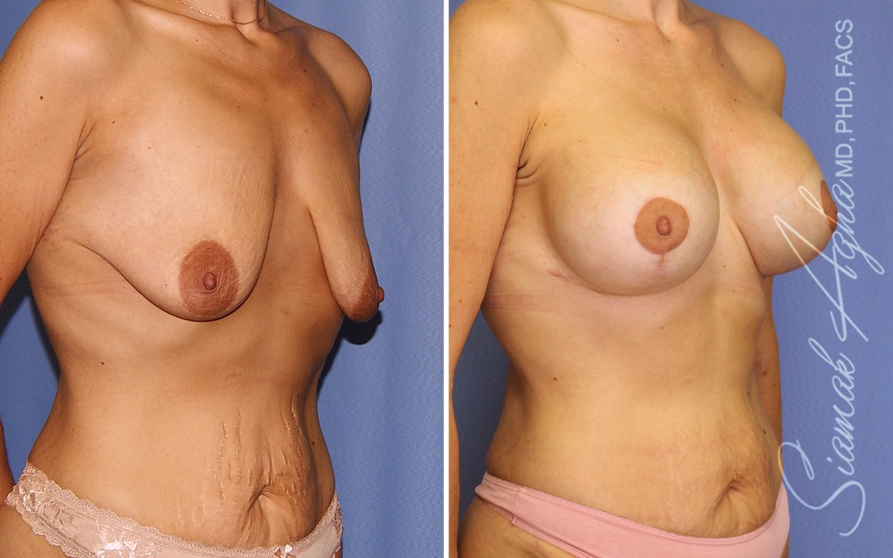 Breast Augmentation Patient 73