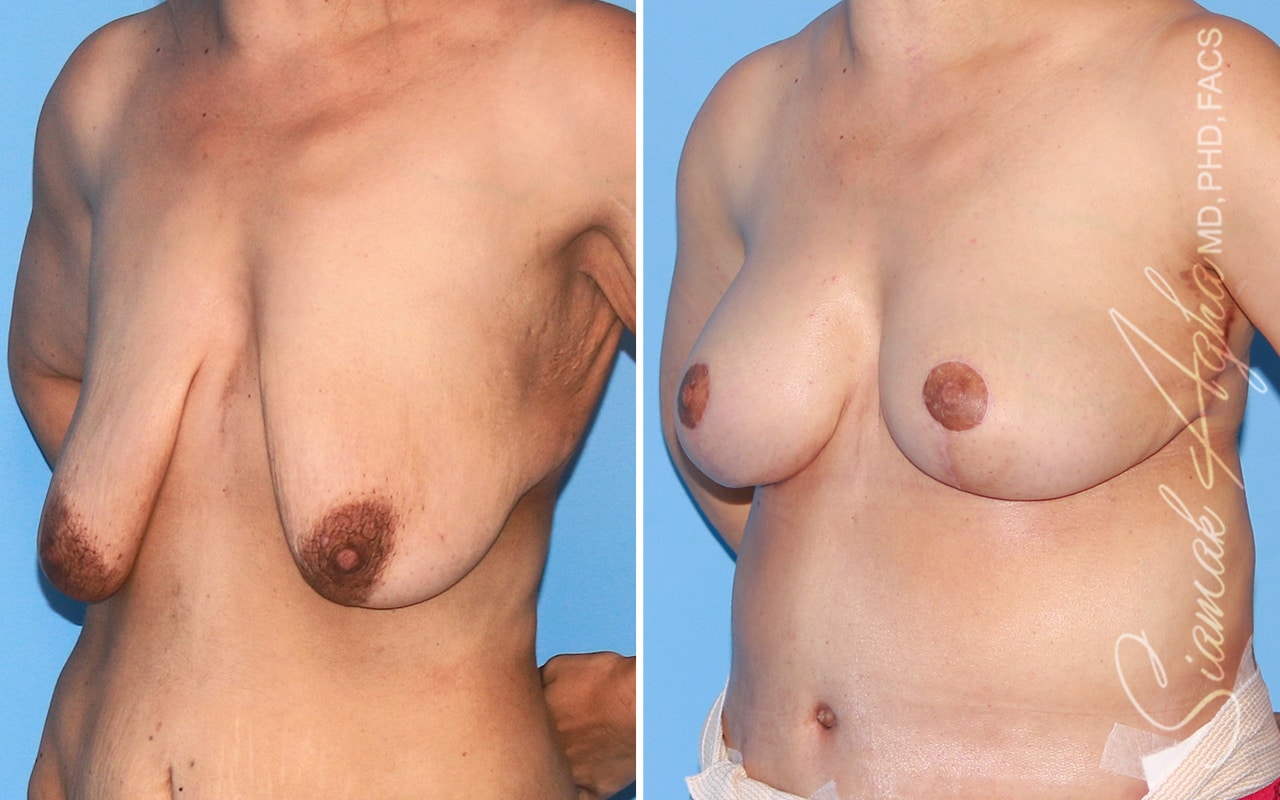 Orange County Breast Augumentation Patient 74 Front Left Newport Beach, CA