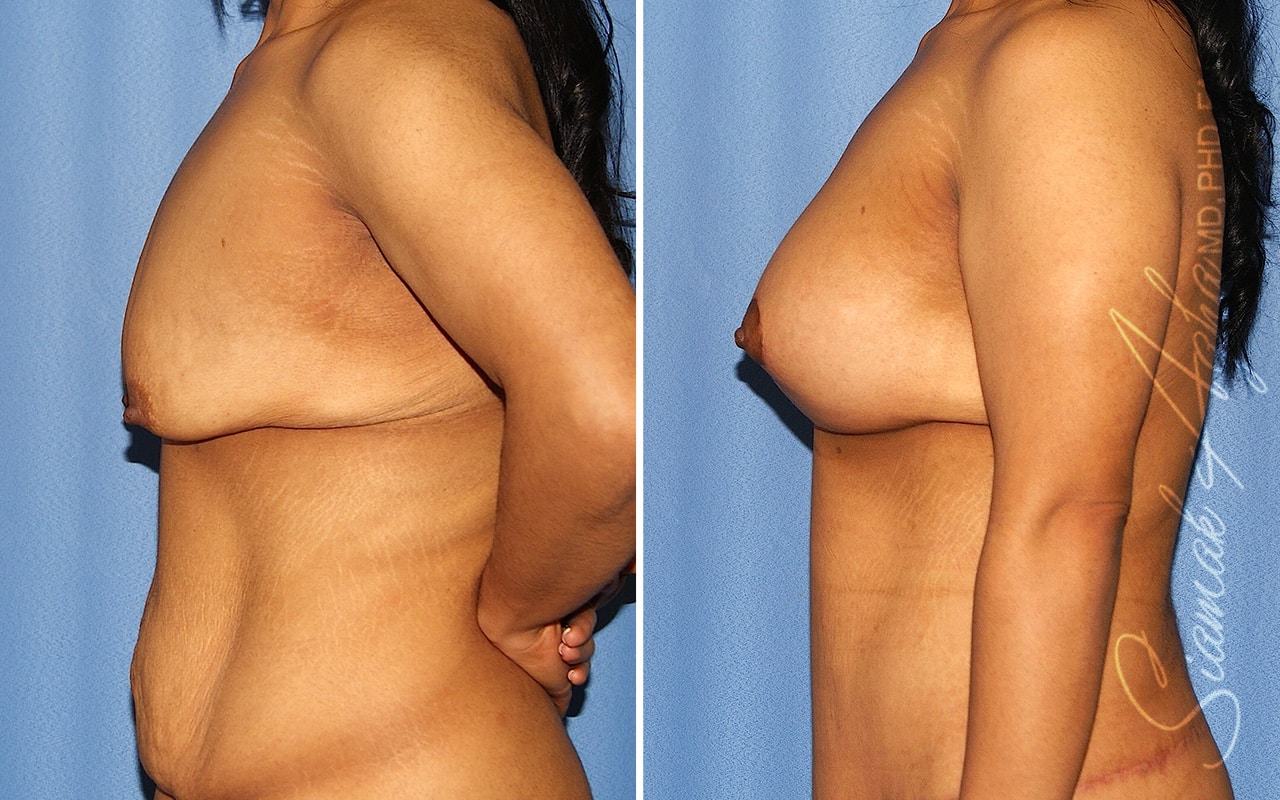 Breast Augmentation Patient 75