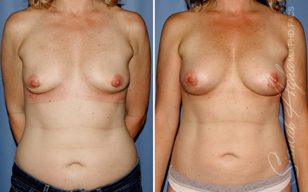 Breast Implants vs. Breast Fat Transfer