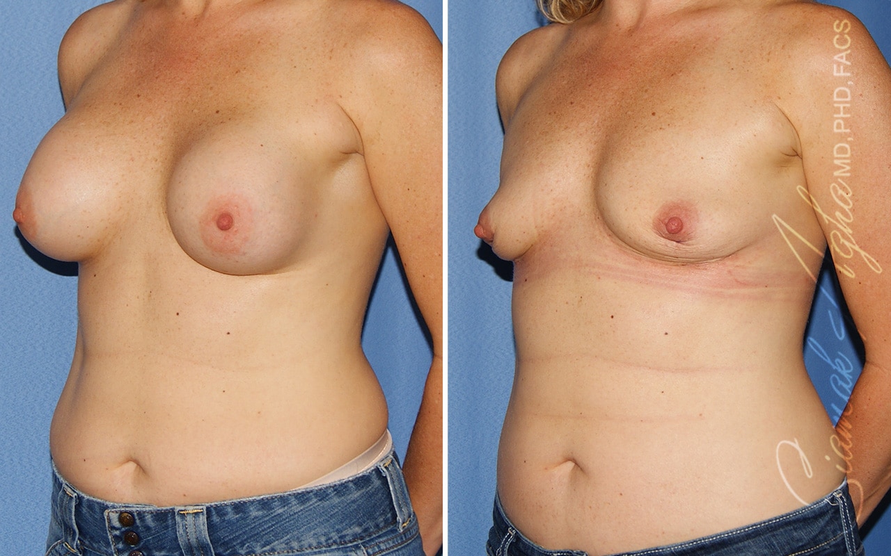 Orange County Breast Implant Removal Patient 01 Front Left Newport Beach, CA