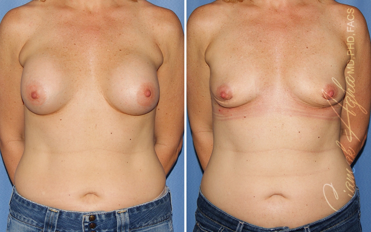 Orange County Breast Implant Removal Patient 01 Front Newport Beach, CA