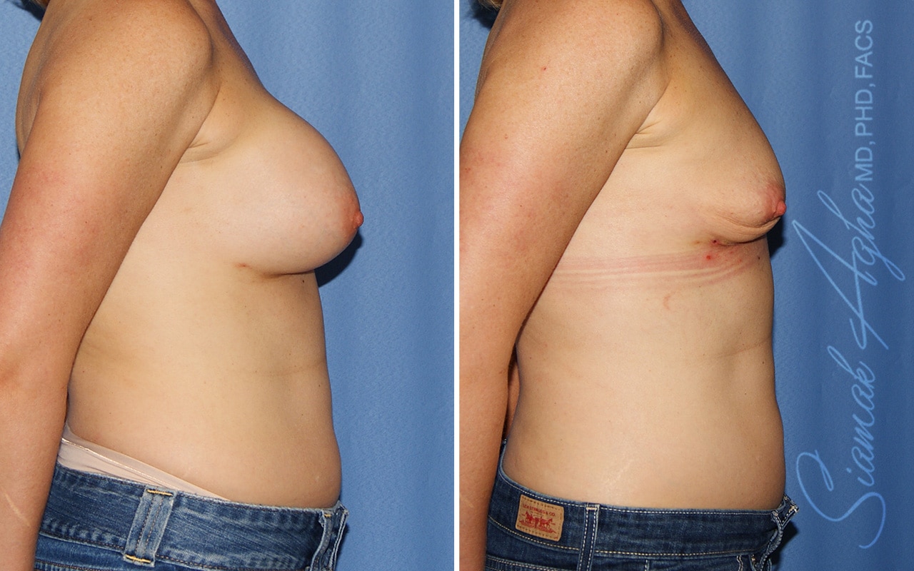 Orange County Breast Implant Removal Patient 01 Right Newport Beach, CA