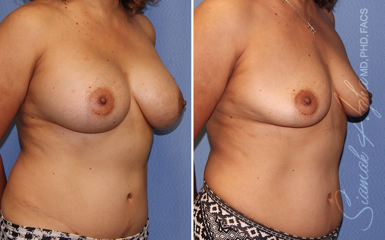 Breast Implant Removal Patient 02